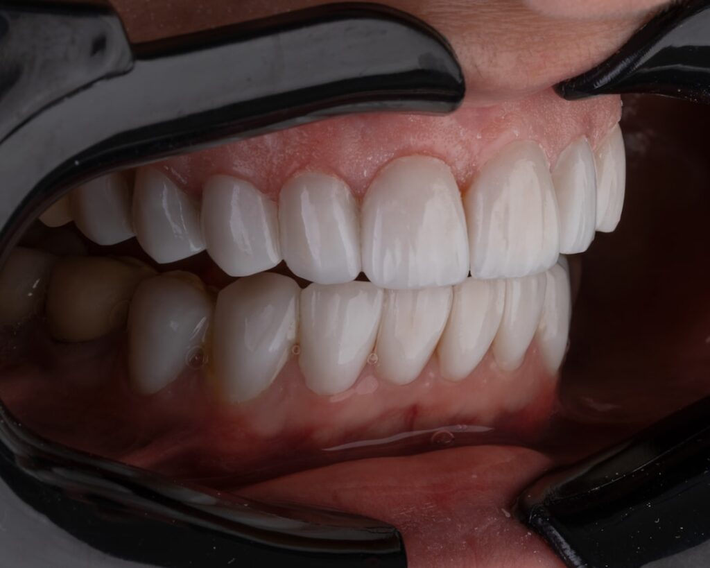 A patient in a dentist's chair receiving a dental implant consultation with X-rays visible on a monitor.