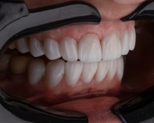 A patient in a dentist's chair receiving a dental implant consultation with X-rays visible on a monitor.