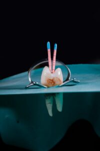 A dentist reviews a dental scan with an adult patient, showing a cross-section of the jaw and implant locations.